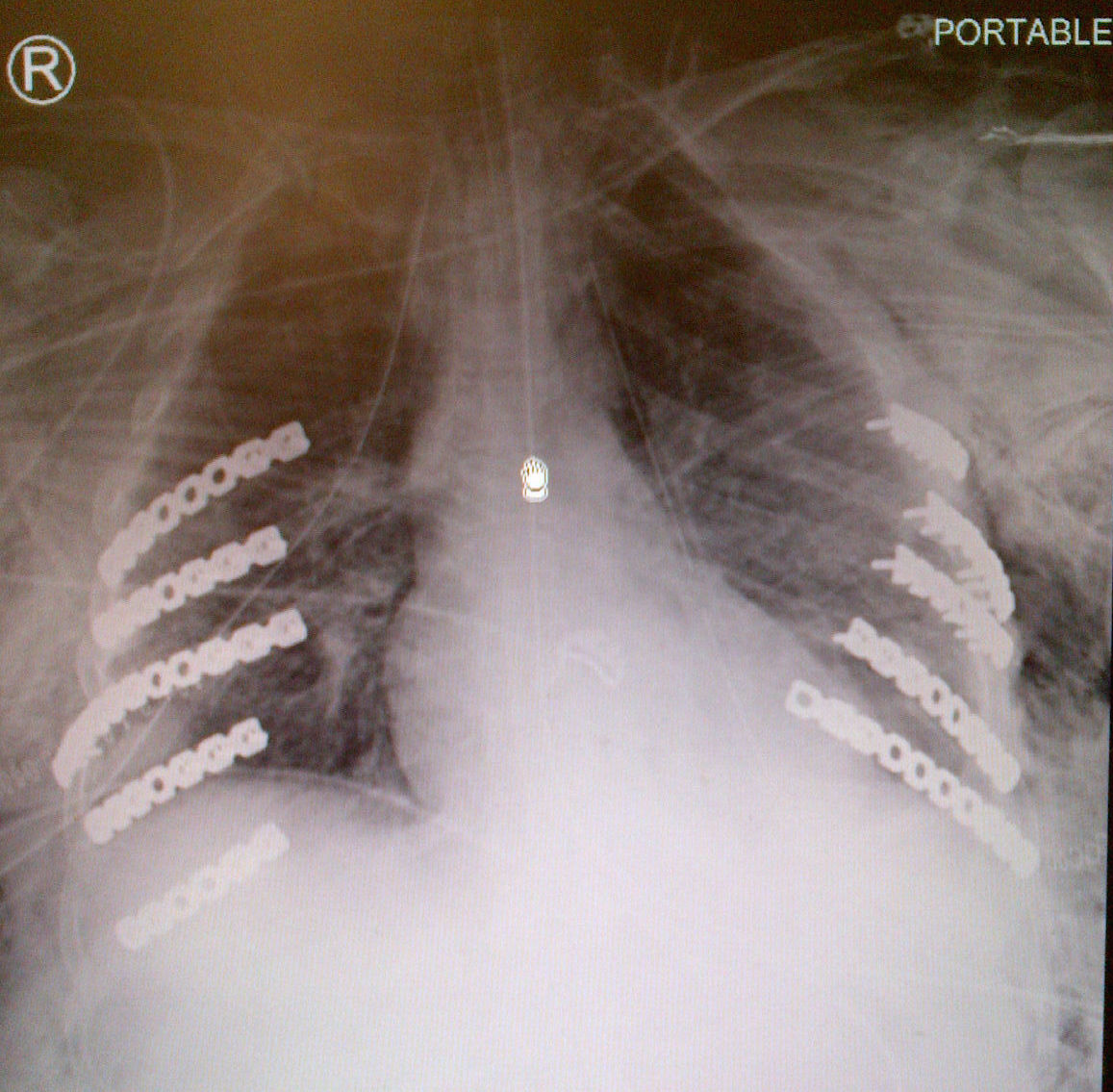 Rib Fracture Plates